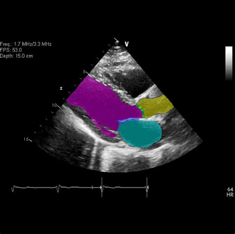 Deep Learning for Cardiac Ultrasound (Echocardiography) by RSIP Vision