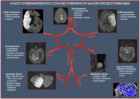 NeuroEMCrit - Time is Brain - Acute Ischemic Stroke Part I: Vascular ...