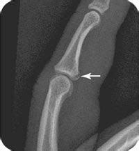 volar plate fractures | Radiology Key