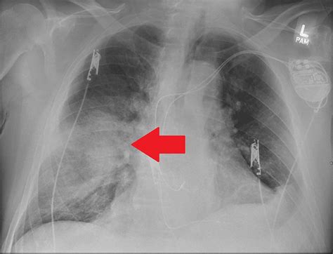 COVID-19 and Cavitary Lesion in Lung | Cureus