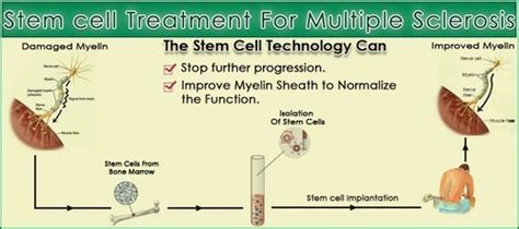 Multiple Sclerosis Stem Cell Therapy Hospitals in India - Expert Chikitsa