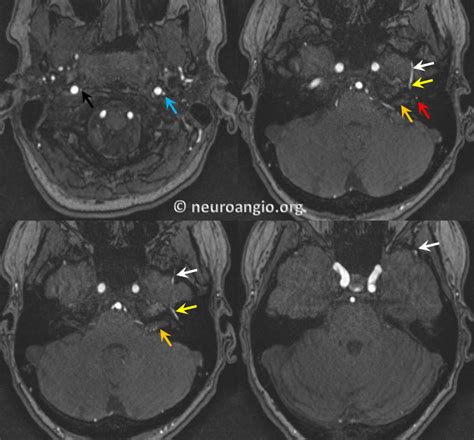 Middle Meningeal Artery | neuroangio.org