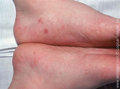 Dyshidrotic Eczema Treatment | National Eczema Association