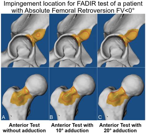 Large Hip Impingement Area and Subspine Hip Impingement in Patients ...