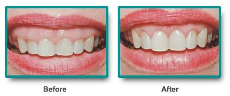 Omni Dental Group: Blog of the Day: Gingivectomy and Gingivoplasty ...