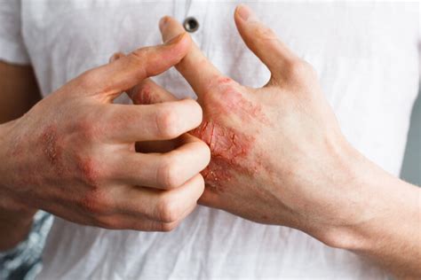 Signs of Eczema - Ingrid E .Trenkle, MD