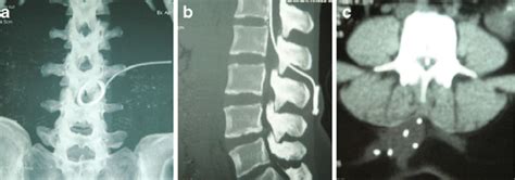 a Plain radiography of the lumbosacral spine-AP view showing slippage ...