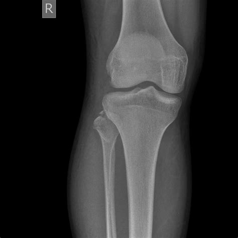 Proximal Fibula Fracture