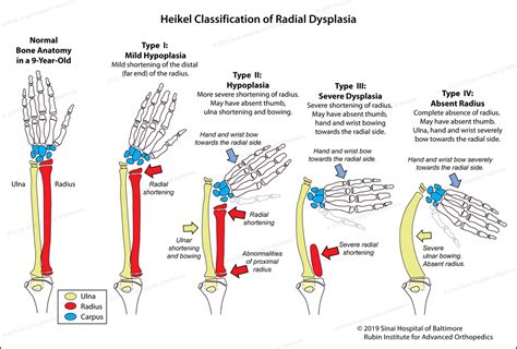 Club Hand | International Center for Limb Lengthening