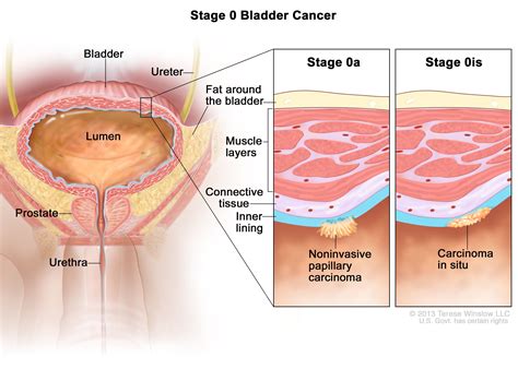 Bladder Cancer Treatment (PDQ®) - NCI