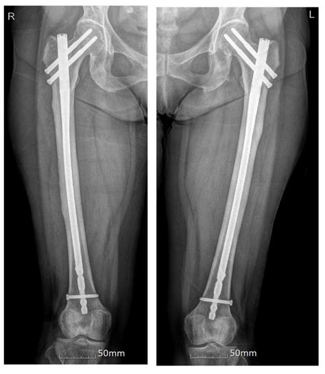 JCM | Free Full-Text | Bilateral Atypical Femoral Fractures after ...