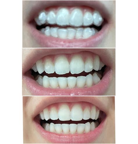 Invisalign Lite (12 inital trays + 11 refinements) - top is first tray ...