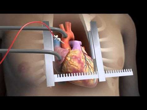 Sternotomy - Open Heart Surgery 3D Animation - YouTube | Open heart ...