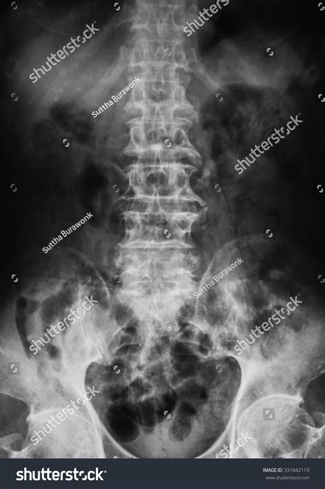 Xray Image Lumbar Spine Shows Osteoarthritis Stok Fotoğrafı 331842119 ...