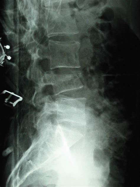 Lumbar Vertebral Fracture - radRounds Radiology Network