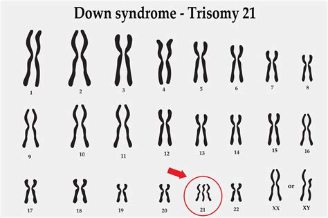 Trisomy 21 Pictures