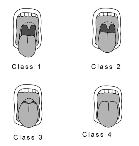 Predicting the difficult airway - WikEM