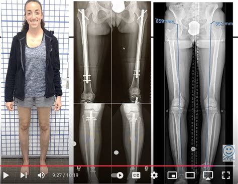 Femoral Retroversion: Causes, Symptoms and Treatments – Limb Lengthening