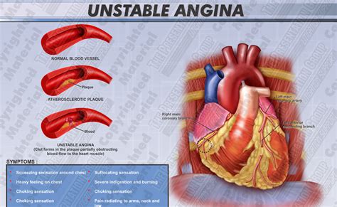 Causes, Symptoms, and Treatment Of Unstable Angina----On Fow24news.com ...