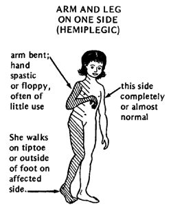 Brian Wright’s Cerebral Palsy “Spastic Hemiplegia/Hemiparesis”