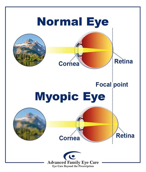 nearsighted vs farsighted which is more common - Charolette Malley