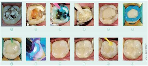 Glass Ionomer - Composite "sandwich" technique: when is the time to etch?