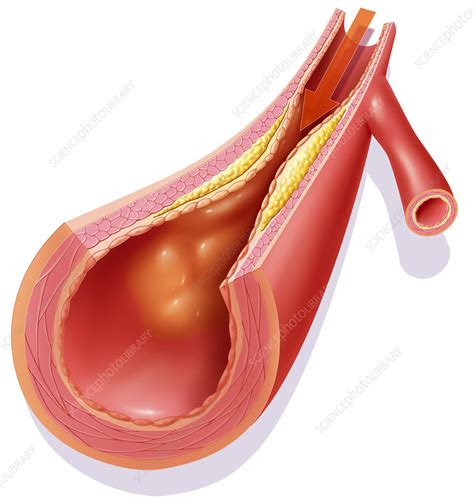 'Atheroma, drawing' - Stock Image - C002/0904 - Science Photo Library