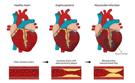 Heart Disease, Hypertension, High Blood Cholesterol - Heart Disease