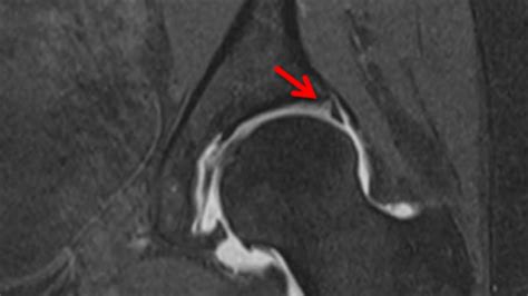 Hip Arthroscopy for Labral Tears - Keck Medicine of USC