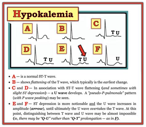 Dr. Smith's ECG Blog: Adding to the many faces of Hypokalemia....