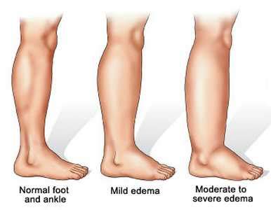 Dropsy-12 Causes, 8 Symptoms, 8 Types and 18 Home Remedies