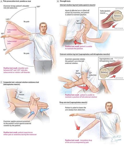 Rotator cuff management series (1/5) – Proactive Physio Knowledge