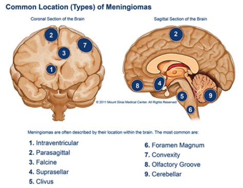 Meningioma | Neurosurgery Tasmania