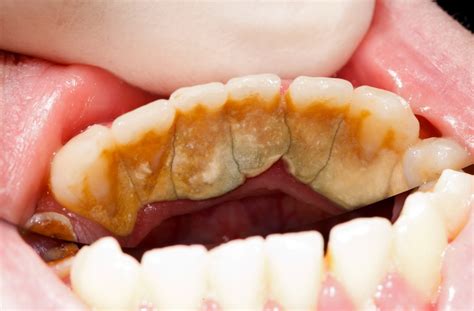 Scaling & Polishing – Wisdom Dental Surgery