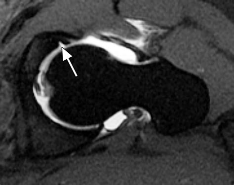 Partial-thickness undersurface anterior labral tear in a 46-yearold ...