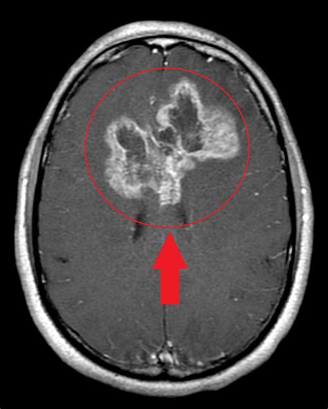 Astrocytoma MRI - wikidoc