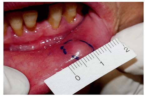 Mucous retention cyst-Causes, Symptoms, Types & Treatment