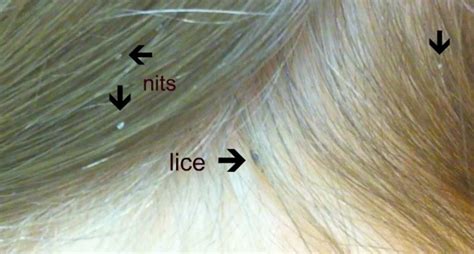 How to Tell Lice