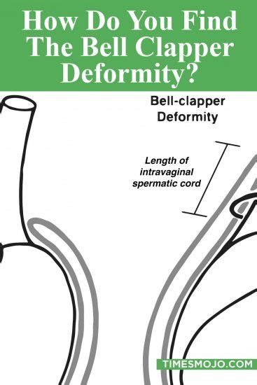 How do you find the bell clapper deformity? - TimesMojo