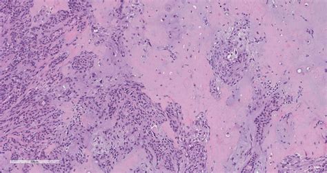 Pleomorphic adenoma – BosnianPathology