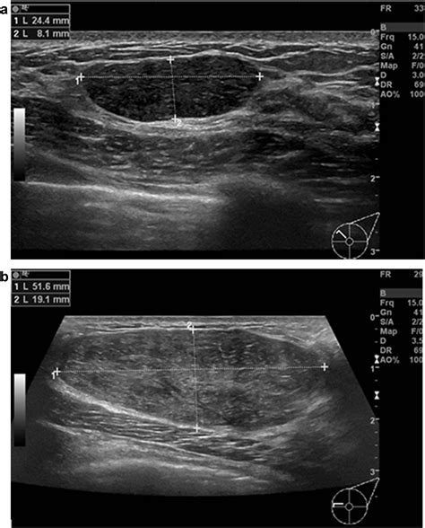 First ultrasound diagnosis of BI-RADS 3 lesions in young patients: Can ...