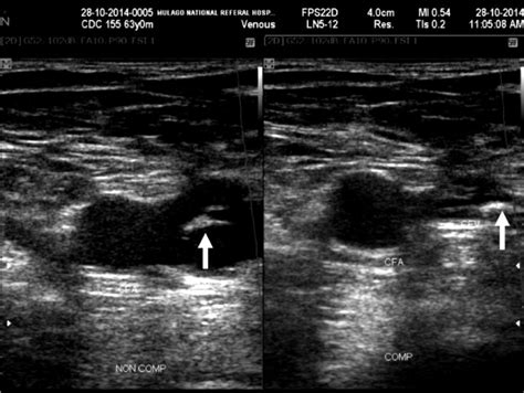 Blood Clot In Leg Ultrasound