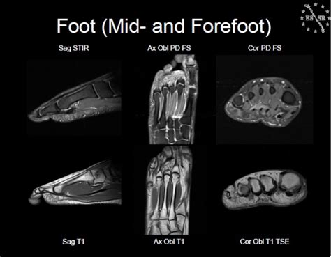 Ankle/Foot MRI