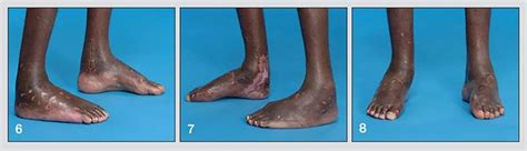 Complex foot deformities: A case study - Mayo Clinic