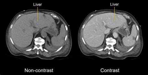 Abdominal CT: Basics • LITFL • Radiology library