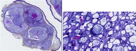 Pleomorphic cells and physaliferous cells in a myxoid stroma ...