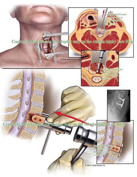 Herniated cervical disc injuries | Atlanta Injury Law Blog