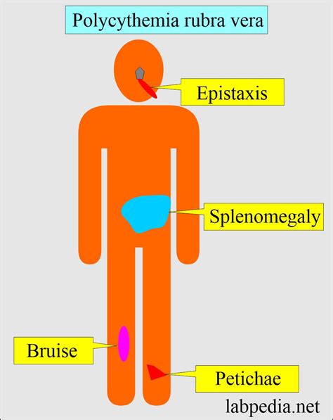 Polycythemia (Erythrocytosis), Polycythemia Rubra Vera, and Secondary ...