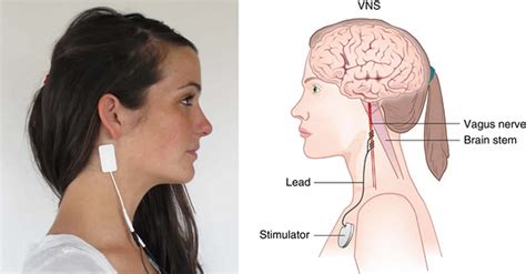 Vagus nerve stimulation, vagus nerve stimulation therapy, uses & side ...