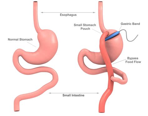 Weight-Loss Procedures | What are Weight-Loss Surgery Requirements ...